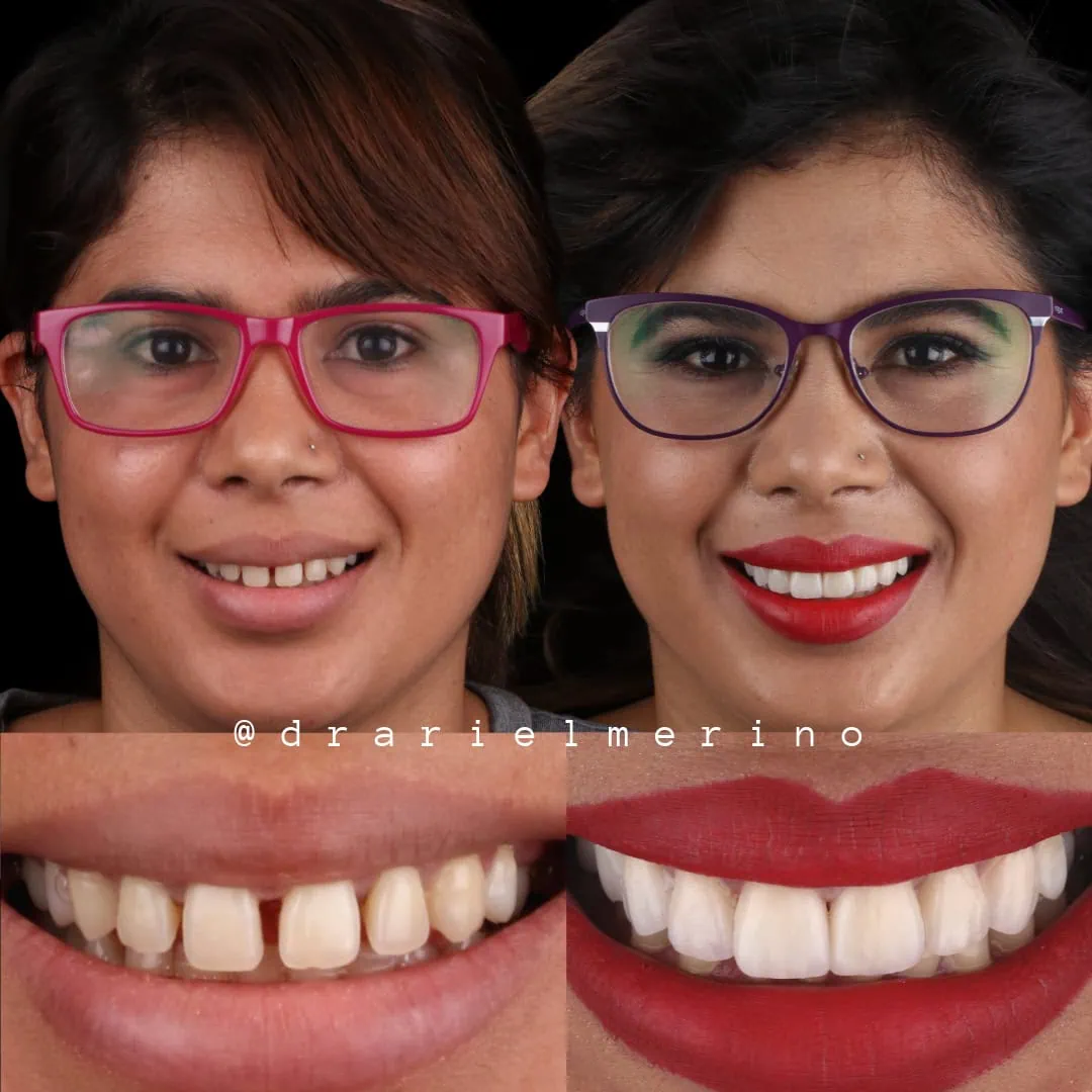 Caso Eli — Transformación con carillas cerámicas antes y después — AM Estética Dental