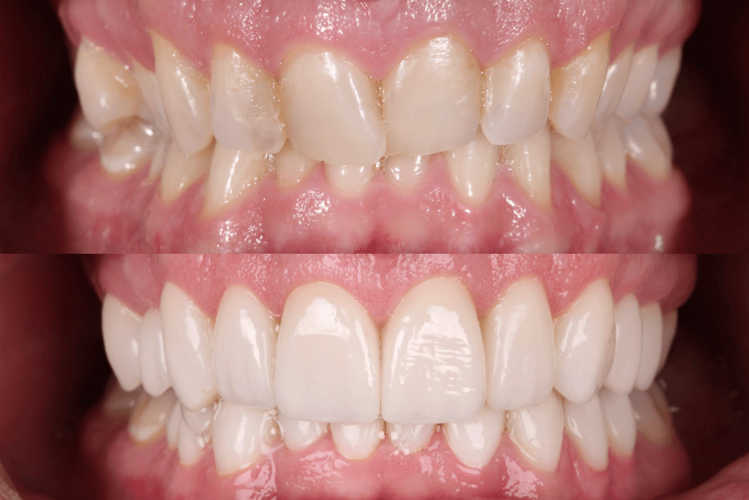 Antes y después — vista intraoral de mordida con 20 carillas de porcelana — AM Estética Dental