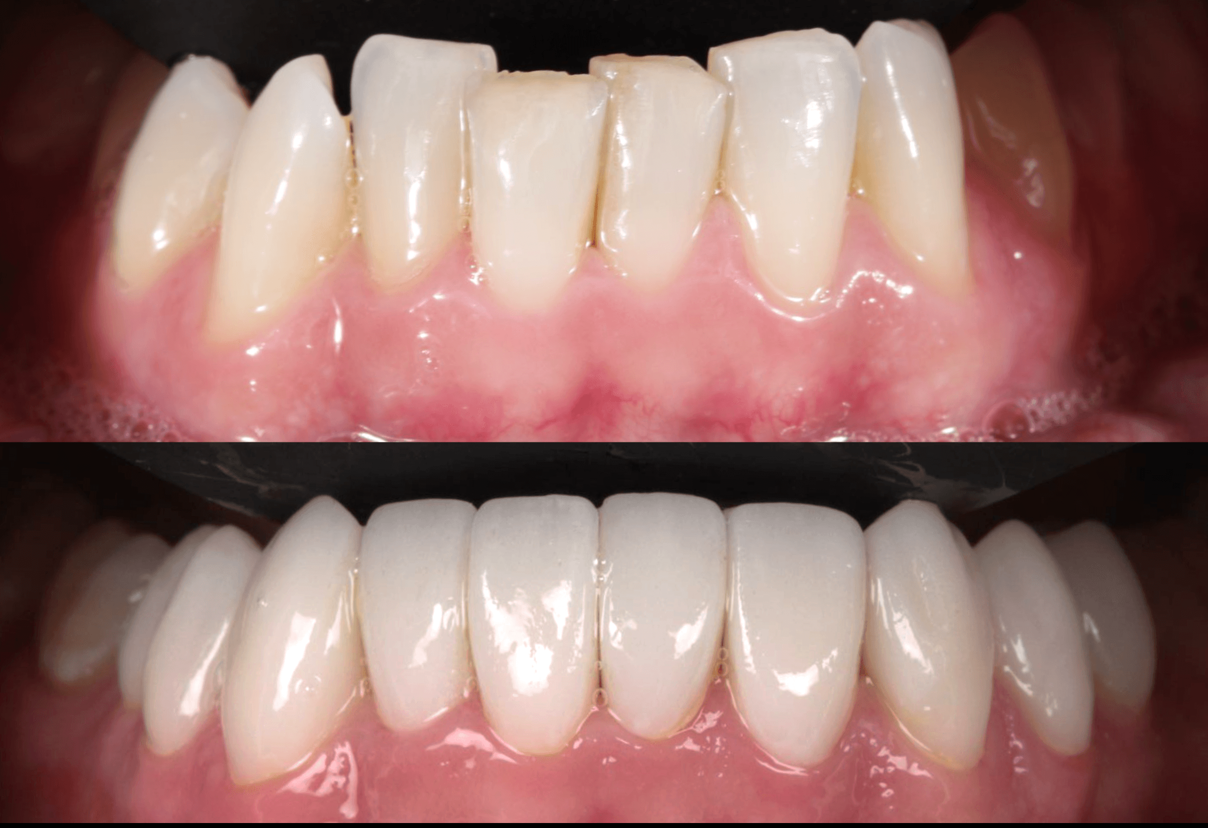 Arcada inferior antes y después — carillas de porcelana mínimamente invasivas — AM Estética Dental