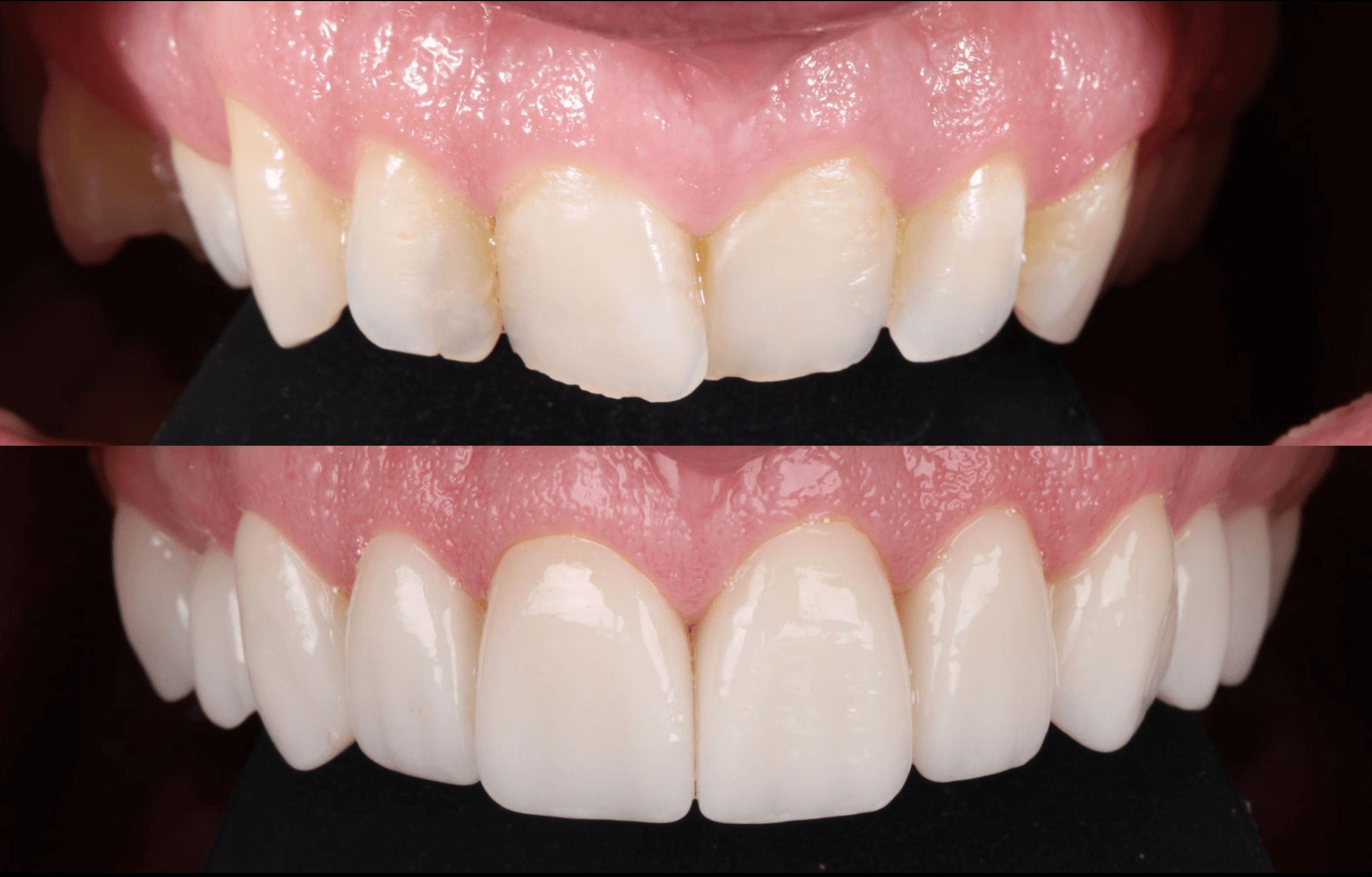 Arcada superior antes y después — carillas de porcelana mínimamente invasivas — AM Estética Dental