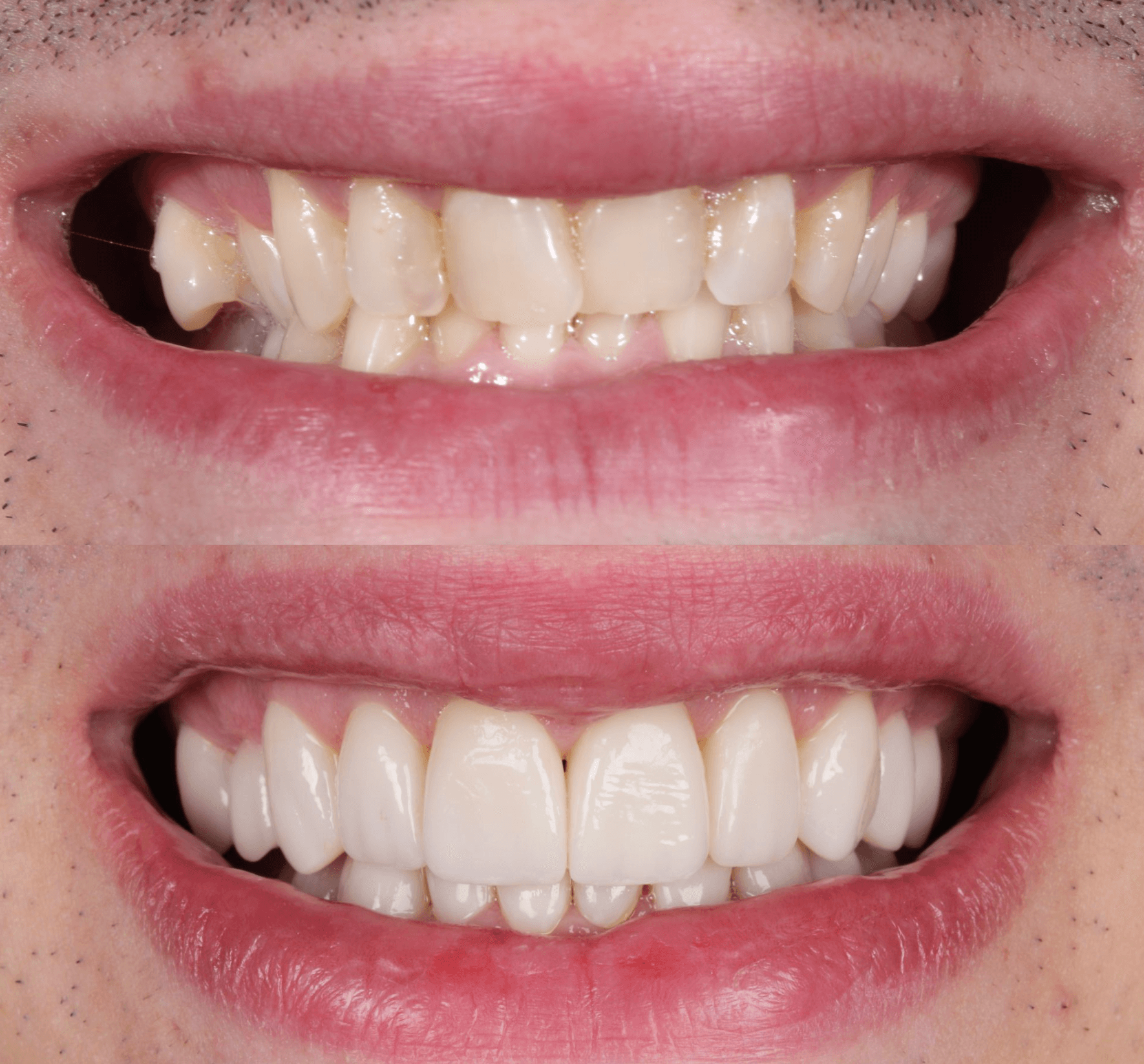 Antes y después sonrisa con labios — 20 carillas de porcelana sin ortodoncia — AM Estética Dental