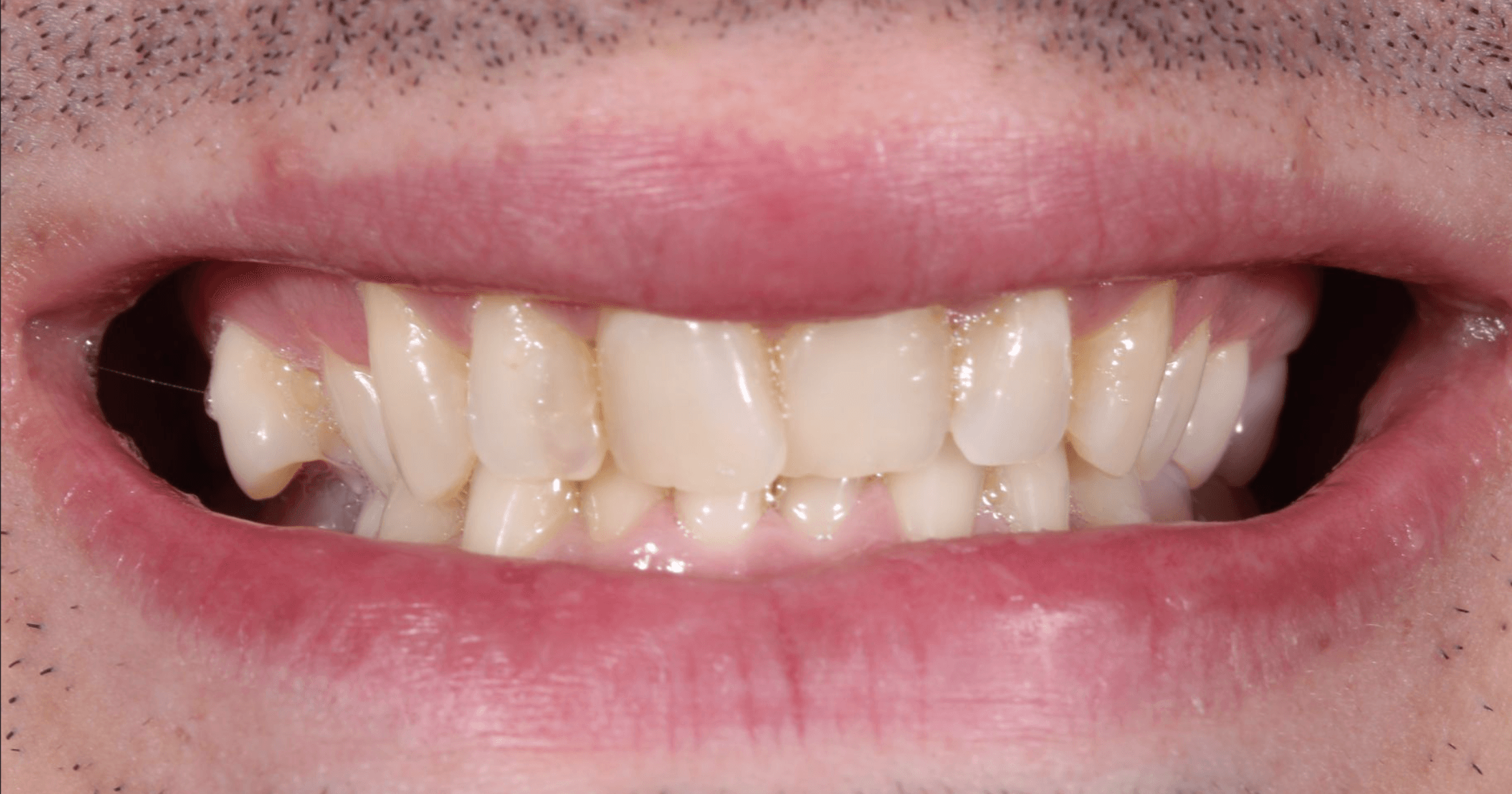 Estado inicial — apiñamiento y desgaste dental antes de carillas — AM Estética Dental