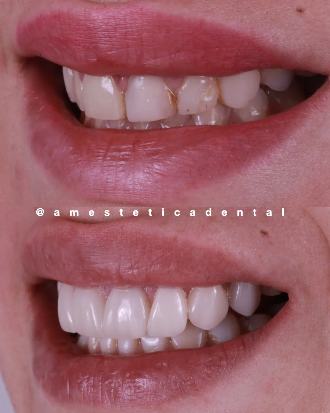 Diseño de sonrisa cerámica en caso de caries — AM Estética Dental