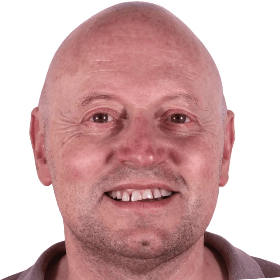 Caso Italiano — Carillas cerámicas AM Estética Dental