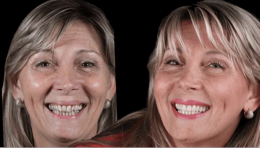 Caso Patricia — diseño de sonrisa con carillas cerámicas — Dr. Ariel Merino